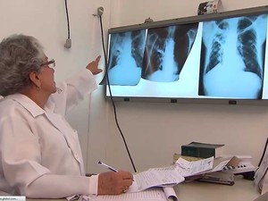 BA lidera entre estados do nordeste em número de casos de tuberculose