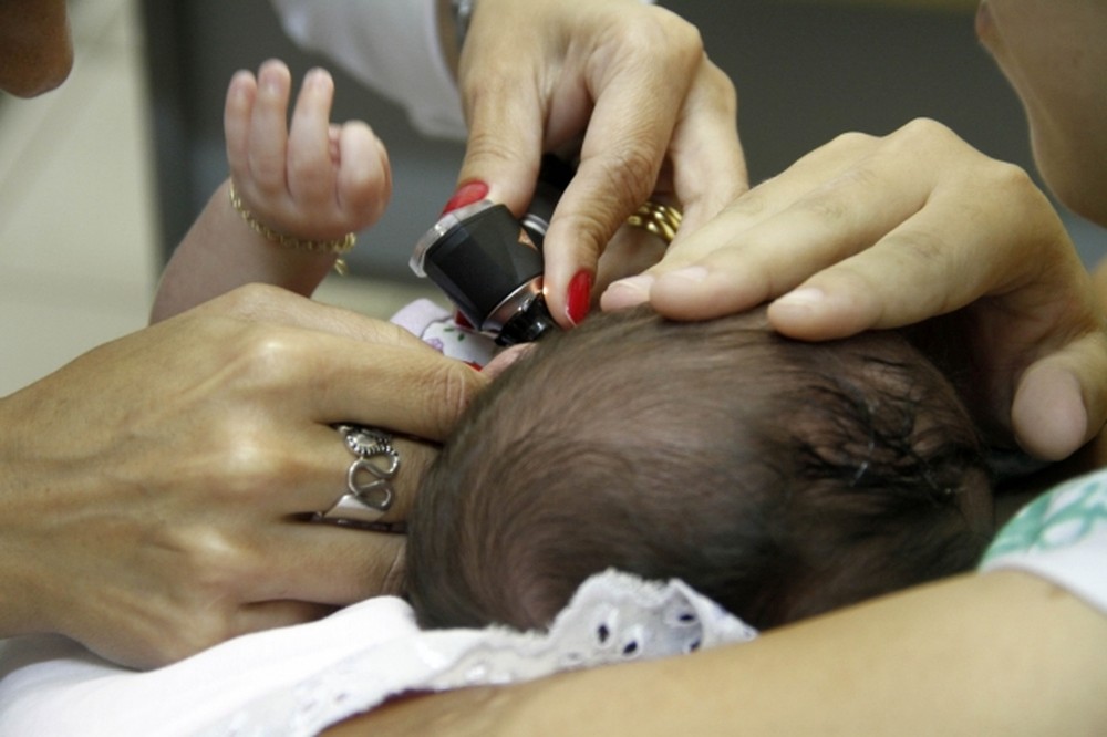 Dois óbitos de bebês com síndrome congênita do zika são investigados em Pernambuco