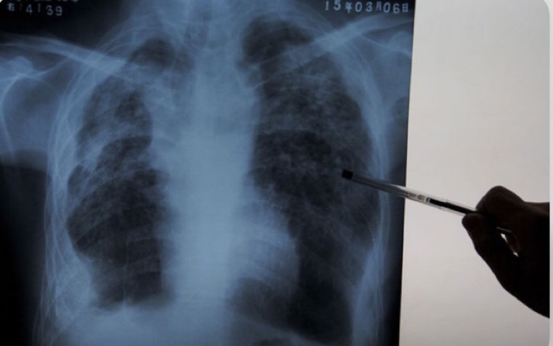 Doença rara e com alta letalidade registra dois casos no Ceará