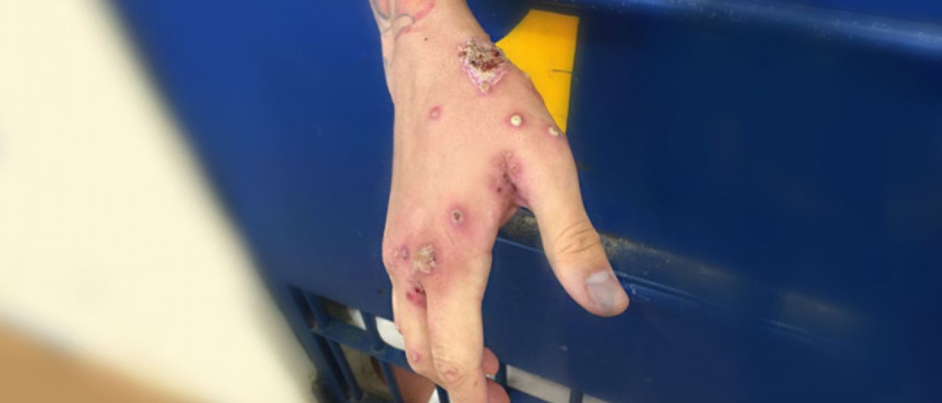 Papuda: sobe nº de presos atingidos por surto de doença contagiosa