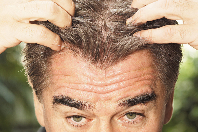 Novo tratamento contra calvície faz o cabelo voltar a crescer