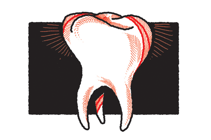 Por que certas pessoas têm cárie mesmo escovando bem os dentes?