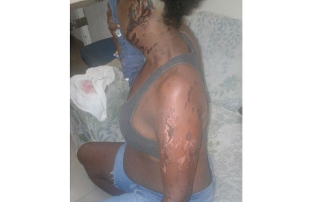 Mulher é atacada com ácido por ex-namorado após término de relação na Bahia: ‘Ameaçou me matar’