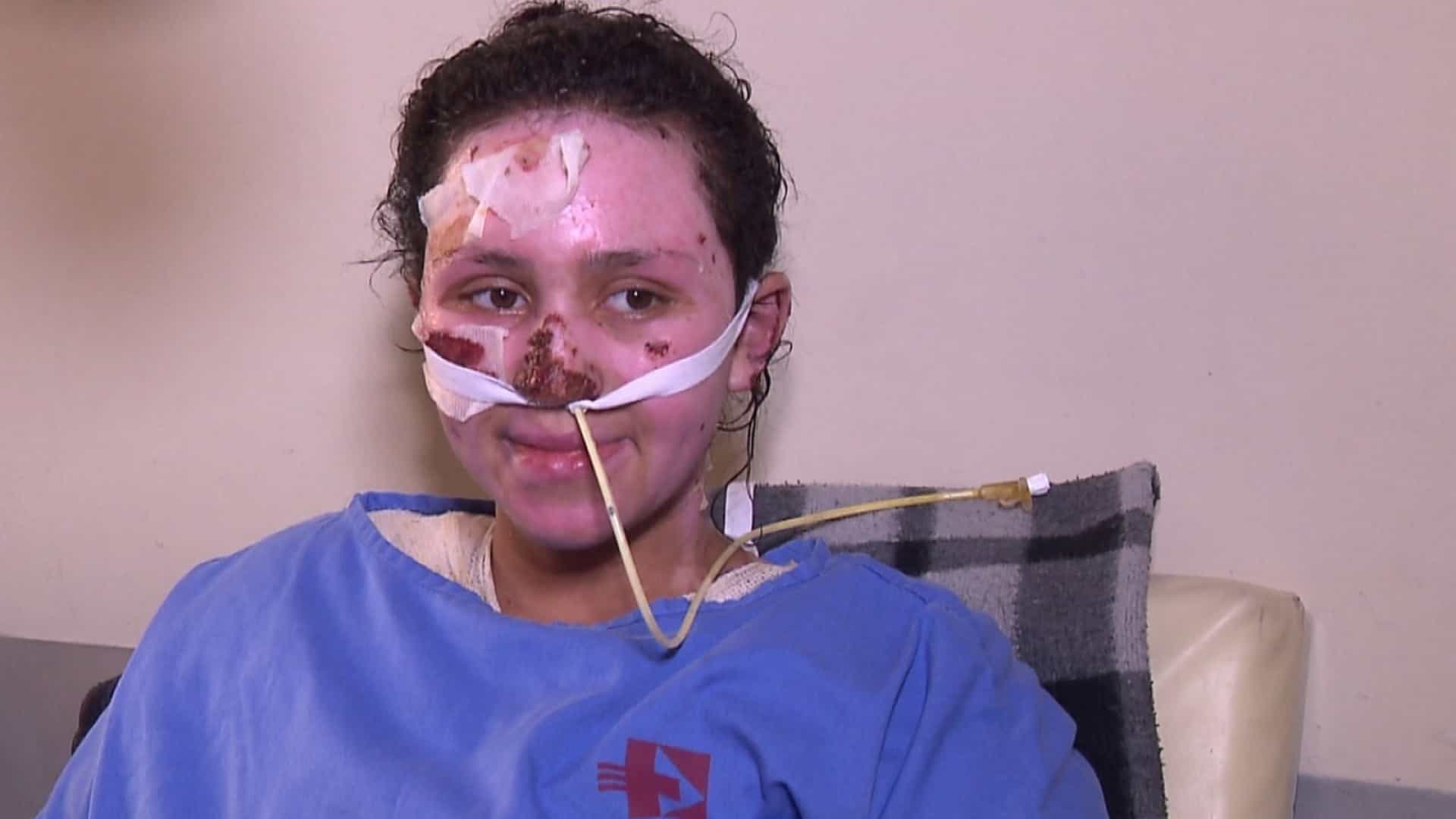 Morre a menina que teve 60% do corpo queimado ao salvar irmão