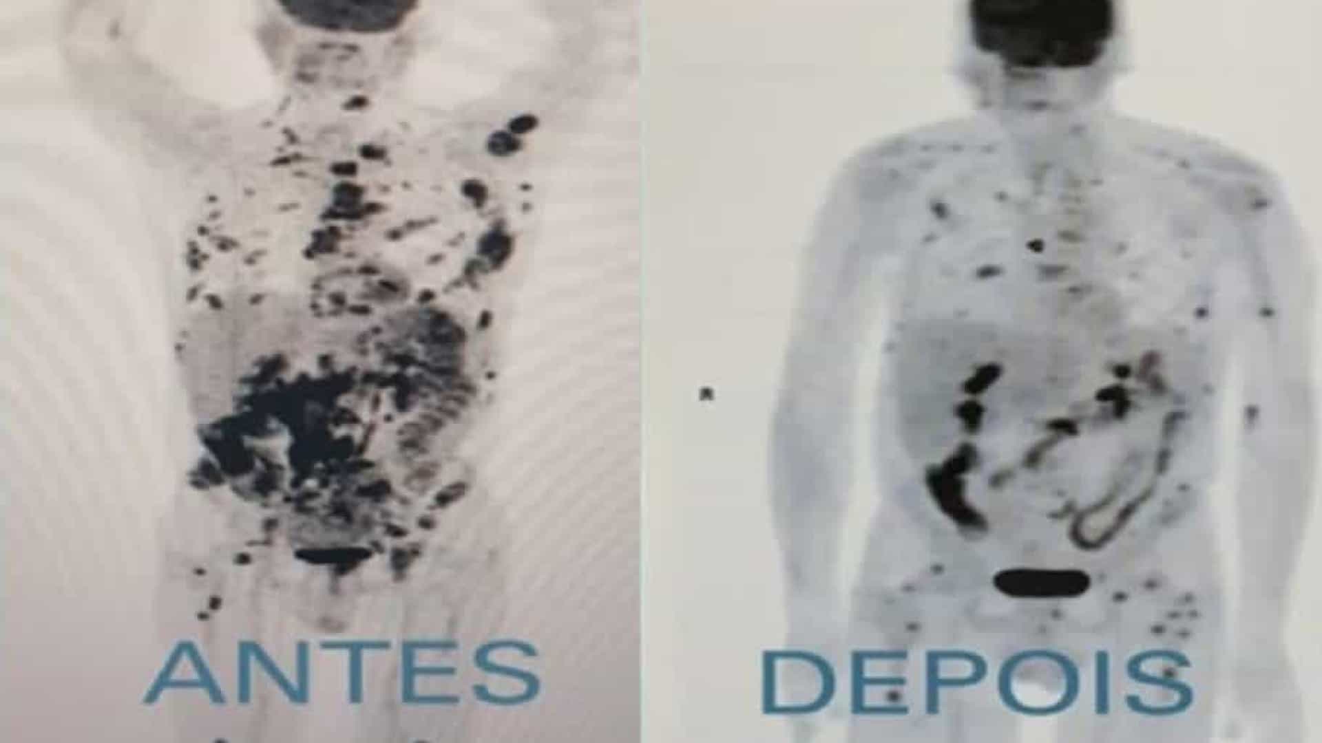 Mais três pacientes farão terapia anticâncer testada por aposentado