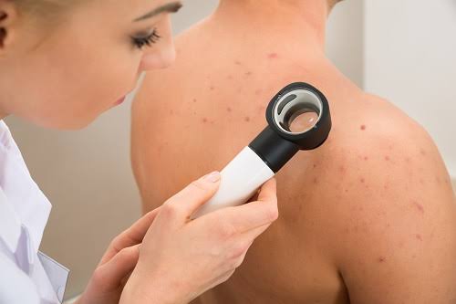 Secretaria da Saúde e Sociedade Brasileira de Dermatologia promovem dia D de combate ao câncer de pele neste sábado, 07