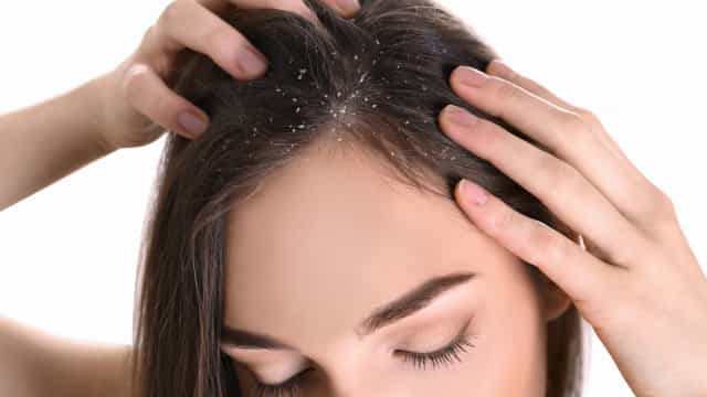 Tem caspa? Prepare esta máscara caseira com açúcar