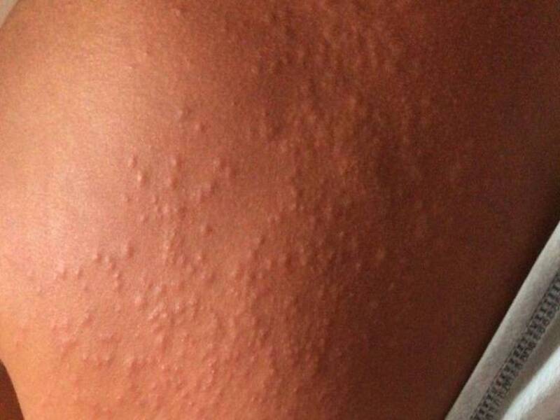 Surto de coceira no Recife foi provocado por mariposas
