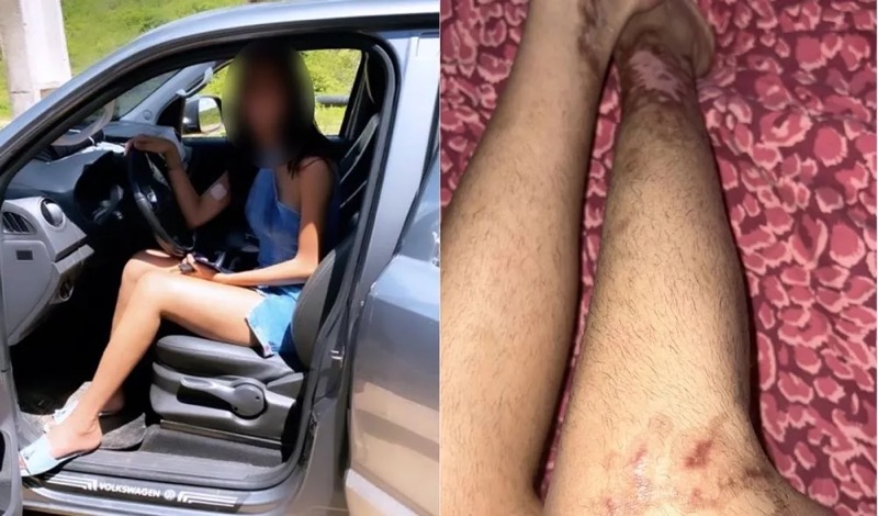 Modelo entra na Justiça após fazer cirurgia no maxilar e ficar com pernas queimadas, em Fortaleza