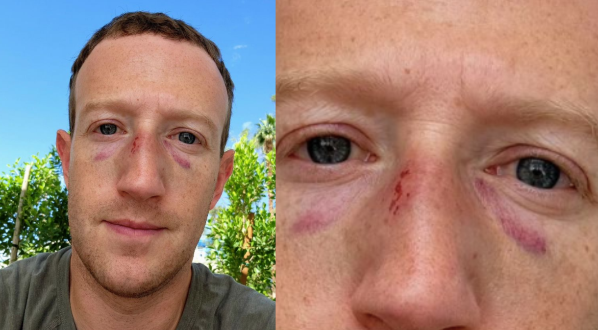 Mark Zuckerberg posta foto com hematomas no rosto depois de luta