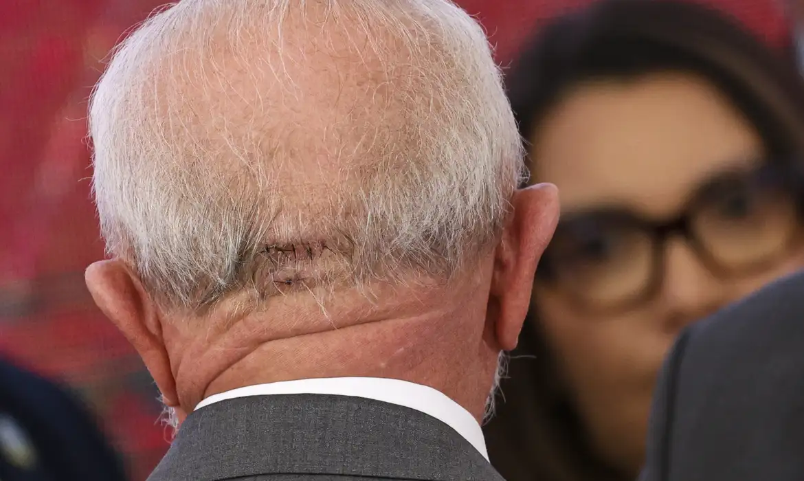 Lula fará novo procedimento médico nesta quinta