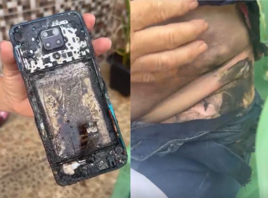 AO VIVO: mulher que teve queimaduras no corpo após explosão de celular deve passar por cirurgia no Hospital Regional do Cariri