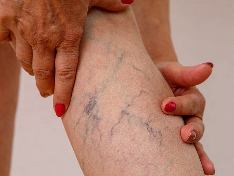 Missão Velha realiza mutirão de tratamento de varizes e amplia atendimentos na rede de saúde