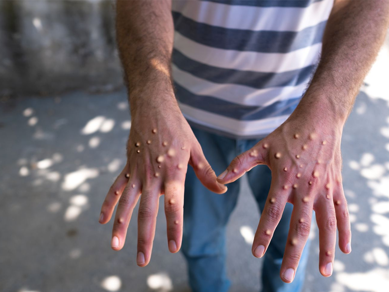 Caso de Mpox é confirmado em Porto Alegre