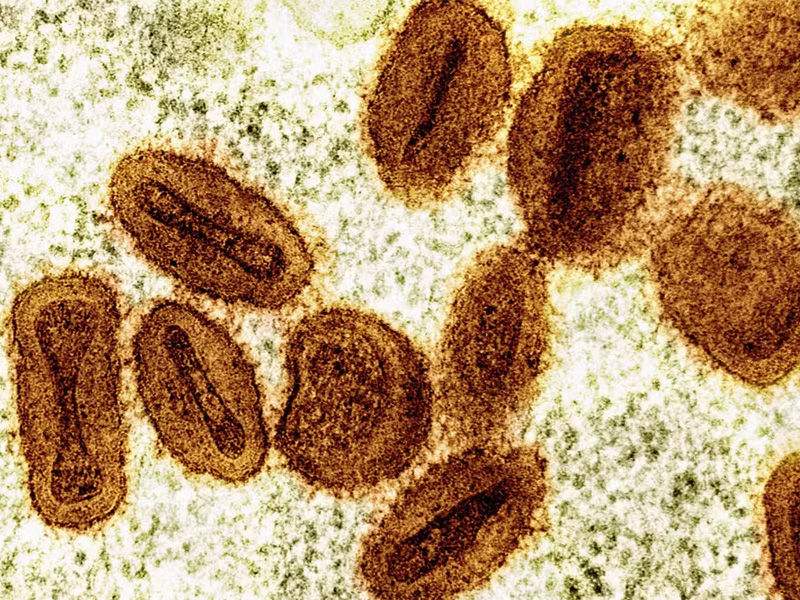 Ceará confirma 3º caso de mpox em 2026 e mantém dois sob investigação