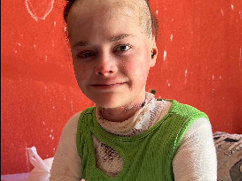 🔴AO VIVO: jovem de 18 anos com doença rara que causa feridas na pele pede ajuda para cirurgias e para reparar teto da casa onde mora, no Crato