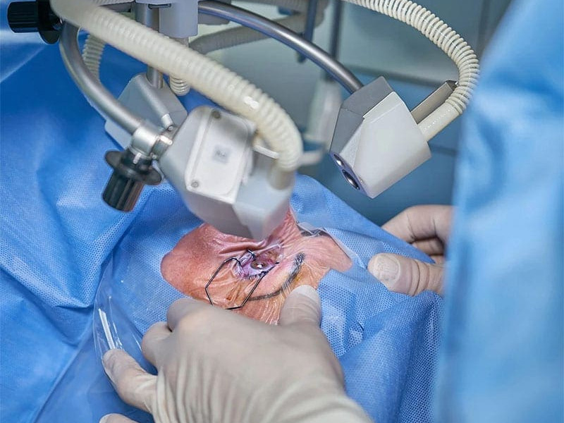 Mutirão de cirurgias de catarata será realizado em Lavras da Mangabeira nos dias 28 e 29 de abril