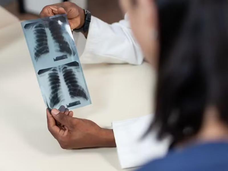 SUS terá três novos medicamentos para tratamento de câncer de pulmão a partir de outubro